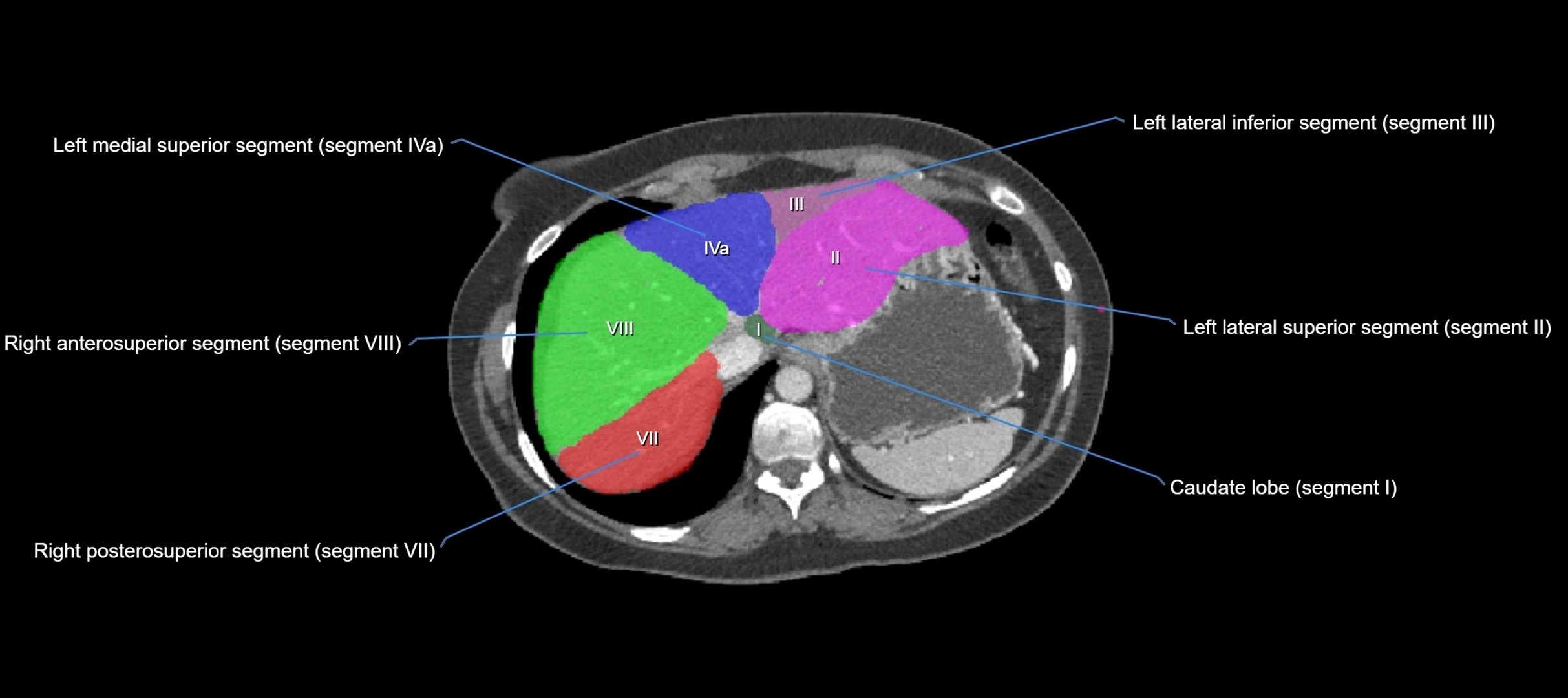 CT liver segments axial cross sectional anatomy labelled image-00063.webp